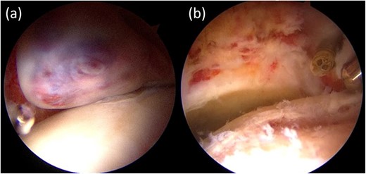 Intra-articular findings of hip arthroscopy before tumor resection (a) and after resection and debridement (b).