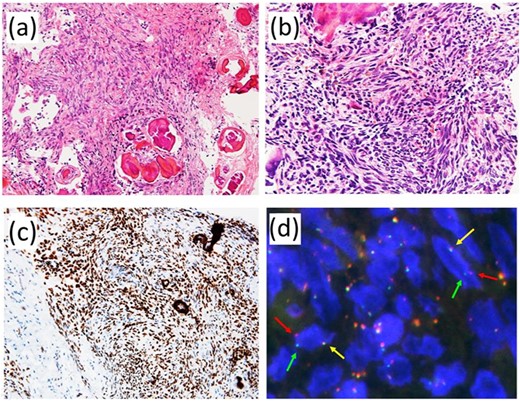 Pathological findings. (a) The lesion consisted of proliferation of spindle-shaped tumor cells with psammomatous calcification. (b) Tumor cells showed relatively monotonous appearance with plump nuclei. No mitotic figures were observed. (c) Immunohistochemically, tumor cells were diffusely and strongly positive for TLE1. (d) Fluorescence in situ hybridization using a dual-color break-apart probe covering SS18 gene exhibited one fused signal (yellow arrow) and one pair of split signals (green and red arrows).