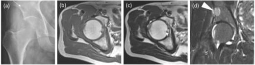 Images after the arthroscopic surgery. (a) The radiograph showed no calcification, which was observed before the arthroscopic surgery, and a stronger radiolucent shadow of the pelvic bone (an arrow). (b) T1WI axial, (c) T2WI axial, (d) coronal short T1 inversion recovery (STIR) sequences did not show the intra-articular lesion and the pelvic lesion got larger (a headless arrow).