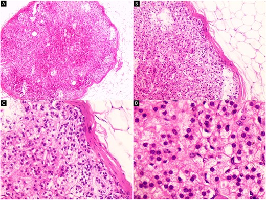 Hematoxylin and eosin-stain (A–D). Microscopic images of the ectopic adrenal cortical nodule. (A) The low-power magnification shows a well-defined encapsulated nodule with adipose tissue around it (x40). (B) The nodule is composed of three adrenal gland cortical layers, zona glomerulosa (beneath the capsule), zona fasciculata (middle layer) and zona reticularis (innermost layer) (x100). (C) Small clusters and cords of polygonal cells with distinct cellular borders with lipid vacuoles are seen (x200). (D) The nuclei are round and located in the center of the cells (x400).