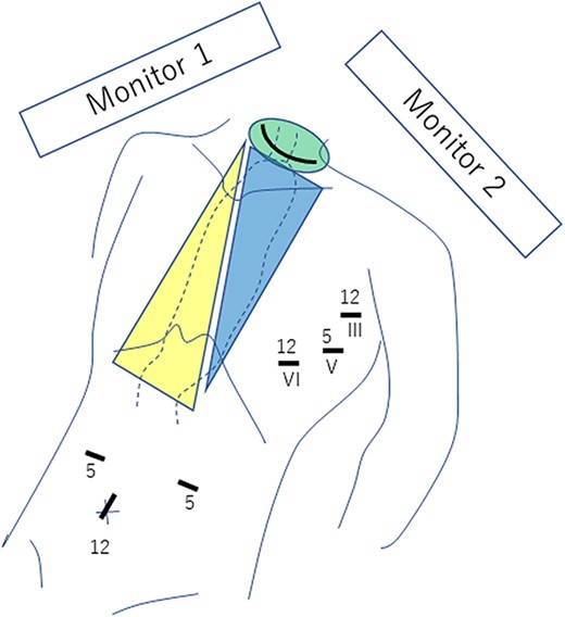 Three ports are placed in both the left chest wall and the abdomen, and a collar incision is performed in the neck. Roman numerals indicate the intercostal space, and the digits reflect the port size (in millimeters). The green area is dissected from the neck, the blue area from the chest and the yellow area from the abdomen. The thoracic surgeon views and operates with monitor 1 from the left side of the patient, while the abdominal surgeon views and operates with monitor 2 from the right side of the patient.