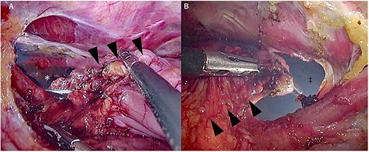 Manipulation around the thoracoabdominal transition. (A) Thoracic view, (B) Abdominal view. ▼ gastric tube, ▲ gastric tube, * abdominal cavity and ‡ thoracic cavity.