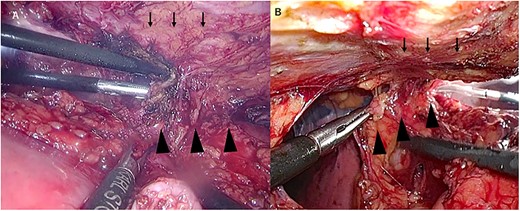 Manipulation around the sternum. (A) Thoracic view, (B) Abdominal view. ↓ sternum and ▲ gastric tube.