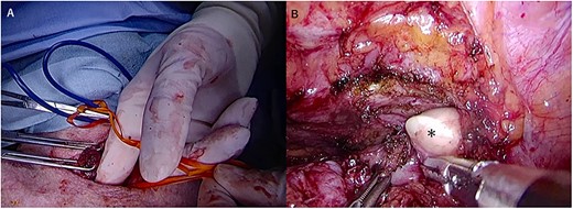 Manipulation around the cervicothoracic transition. (A) Cervical view, (B) Thoracic view. * Surgeon’s fingers during cervical manipulation.