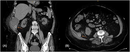CT scan demonstrating retained gallstone with associated abscess ~62 × 86 × 98 mm in the right flank involving the right posterior transverse abdominis/internal oblique muscle in the coronal (A) and axial (B) views.