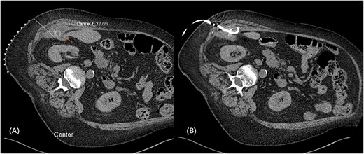 CT-guided pigtail re-insertion pre-operatively to assist localization of gallstone (A); drain placed in the right subhepatic collection located within the transverse abdominis muscle (B).