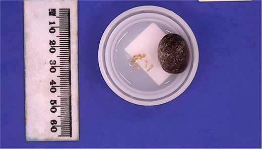 Retrieved gallstone measuring 18 × 15 × 14 mm, weighing 3 g and multiple loose fragments of tan tissue 5× 4 × 1 mm in aggregate.