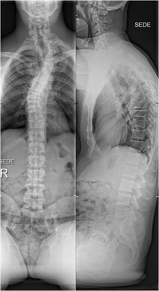 The initial X-ray images of the thoracic spine at the time of admission to our institution. Anteroposterior view (left) and lateral view (right).