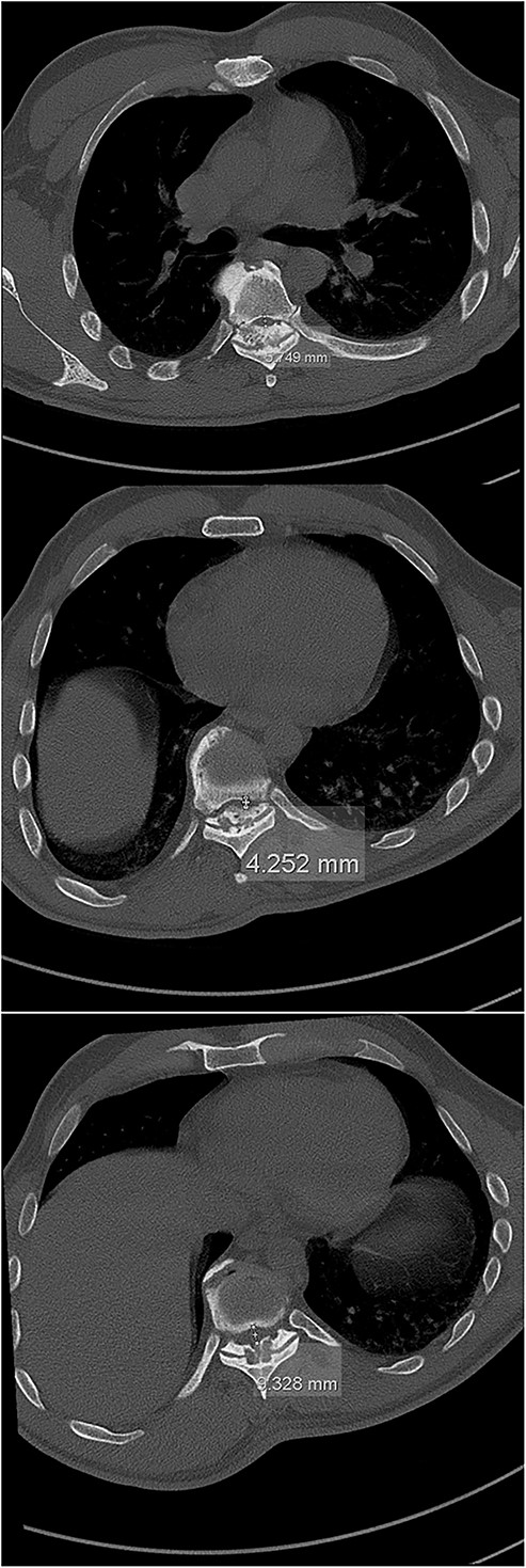 The initial CT scan (axial views), showing the width of the spinal canal at Th6 (above), Th9 (middle) and Th11 (below).