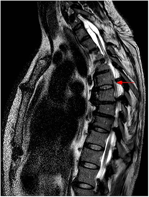 MRI scan of the thoracic spine at the time of admission, with hyperintense intramedullary T2 signal at Th6, indicating myelopathy (red arrow).