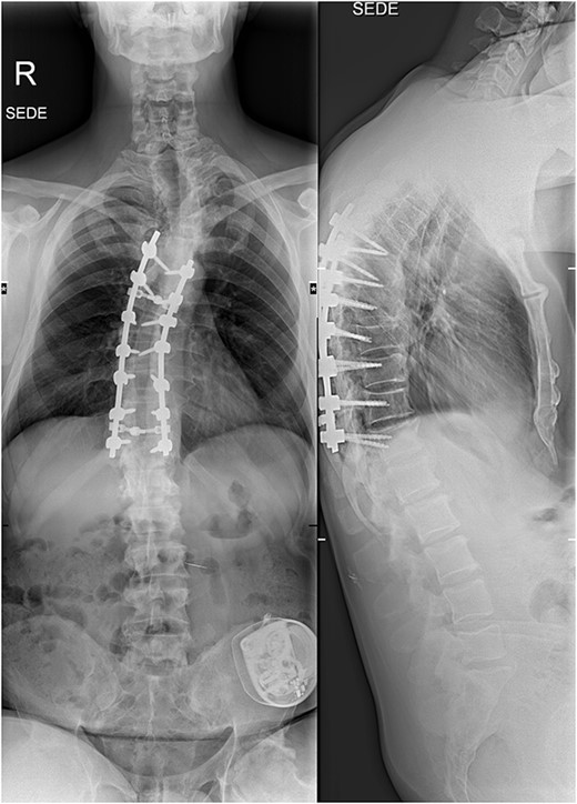 X-rays at the final follow-up 4 years after the surgery. Anteroposterior view (left) and lateral view (right).