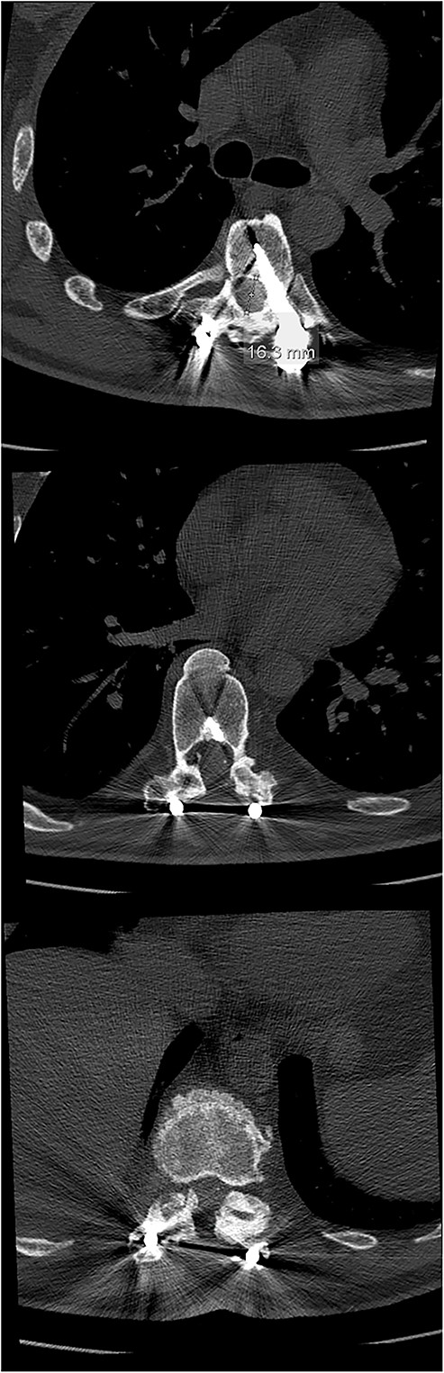 Final follow-up CT scan (axial views), showing adequate width of the spinal canal at Th6 (above), Th9 (middle) and Th11 (below).