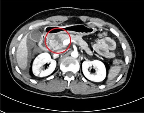 CT abdomen—sagittal section, showing transection of the pancreas (circle).