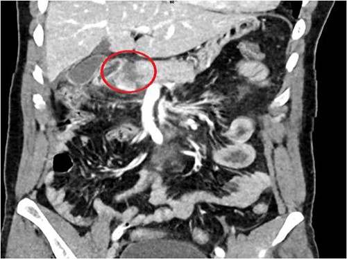 CT abdomen—coronal section, showing transection of the pancreas (circle).
