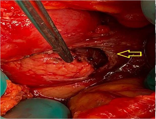 Intraoperative: pancreas seen through a laceration in the lesser sac (arrow).