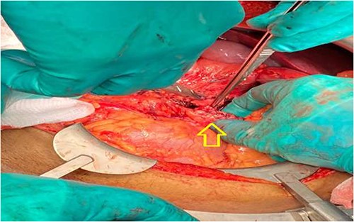 Intraoperative: transected ends of pancreas oversewn (arrow).