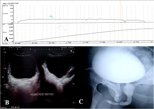 (A) Uroflowmetry, (B) bladder ultrasound, (C) utrethro-cystogram.