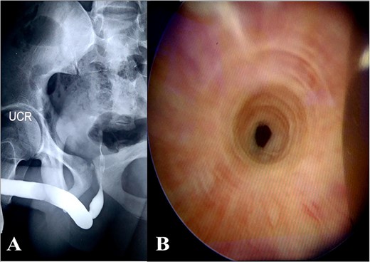 (A) Urethrogram, (B) urethroscopy.