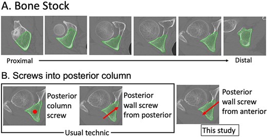 Bone stock and screw into the posterior column. Thick and strong bone stock in the posterior column is shown from proximal to distal. The screw direction is shown by a red dot or arrows. The posterior column screw is indicated by a dot because the screw is inserted into the posterior column from proximal to distal.