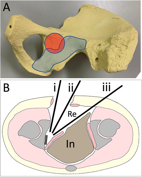 Approach images (A). The red area indicates the acetabular joint. In the blue area, screws can be inserted (B). (i) Drilling and screwing direction of the ilioinguinal or pararectus approach. (ii) Drilling and screwing direction of the modified Stoppa approach. (iii) Drilling and screwing direction with the sleeve guide technique. Re, retroperitoneal area. In, intra-abdominal area.