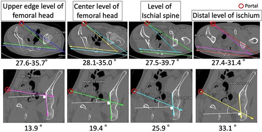 Estimated screw angles, Example CT images are shown from the upper edge level of the femoral head to the distal part of the ischium. The upper row shows inclined axial plane images, and the lower row shows inclined coronal plane images. Estimated screw angles to plate from the portal site to the posterior column are measured.