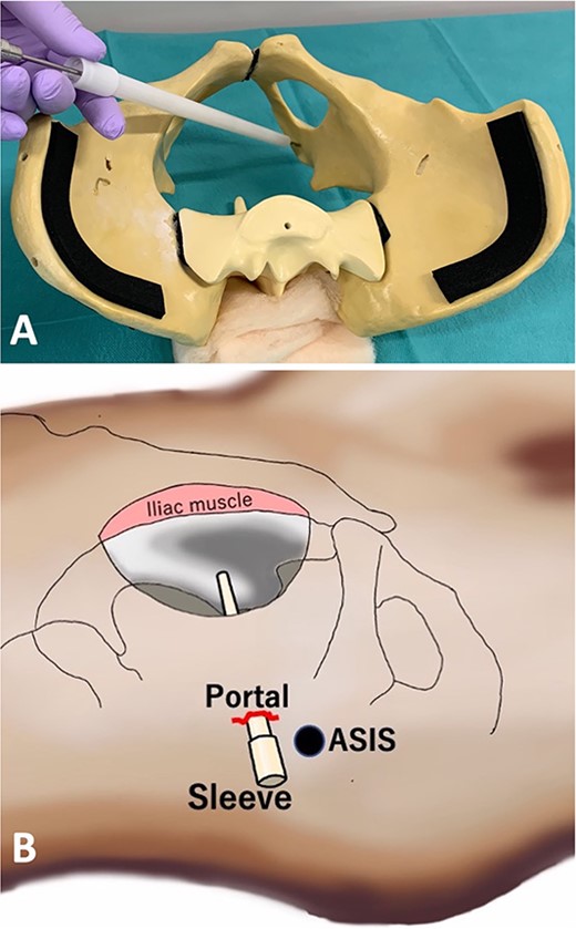 Actual direction of the sleeve using a pelvic model (A) and scheme (B).