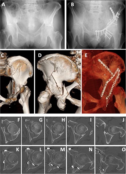 Case 1 images: (A) pre-operative X-ray, (B) post-operative X-ray, (C) pre-operative 3D-CT (anterior), (D) pre-operative 3D-CT (posterior), (E) post-operative 3D-CT, (F–J) pre-operative axial CT images, (K–O) post-operative axial CT.