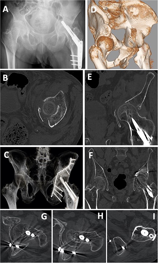 Case 2 images: (A) pre-operative X-ray, (B) pre-operative axial CT image, (C) post-operative X-ray, (D) pre-operative 3D-CT, (E) pre-operative coronal CT image, (F) post-operative 3D-CT, (G–I) post-operative axial CT images. Screws are inserted into the posterior wall (G, H) and near the ischial tuberosity (I).