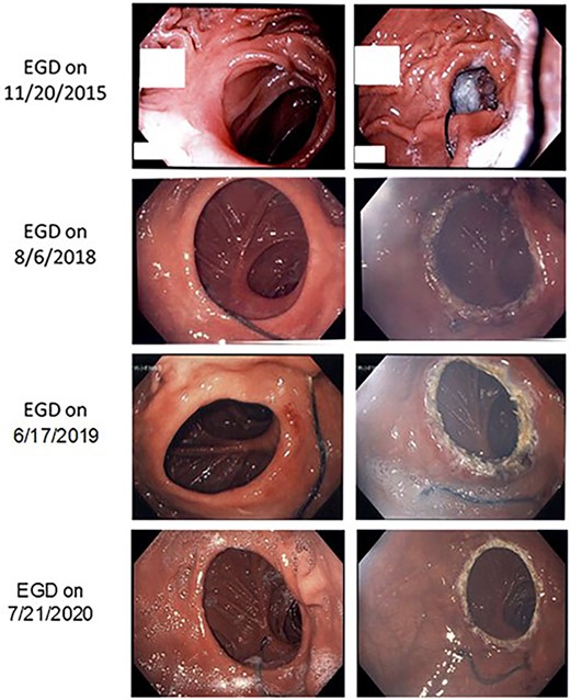 Images are shown during EGD at different time periods. The left panel shows pre-intervention, and the right panel shows post-APC intervention (no intervention on 20 November 2015).