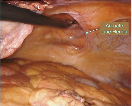Intraoperative incidental finding of bilateral arcuate line hernias.
