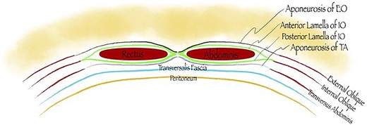 Posterior sheath is comprised of fibers from the aponeurosis of the transversus abdominis and the posterior lamella of the internal oblique (cranial to the arcuate line).