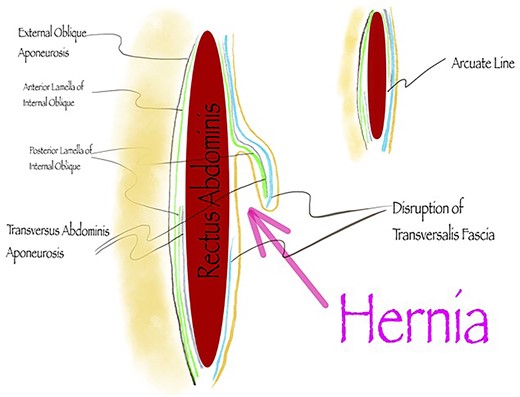 Herniation at the arcuate line into the pre-transversalis fascial plane.