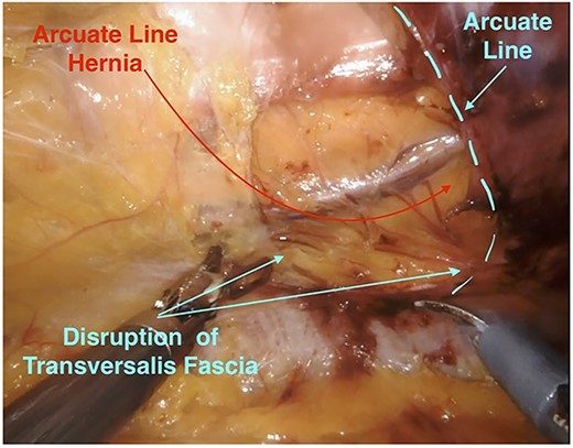 Arcuate line hernia (intraoperative view).