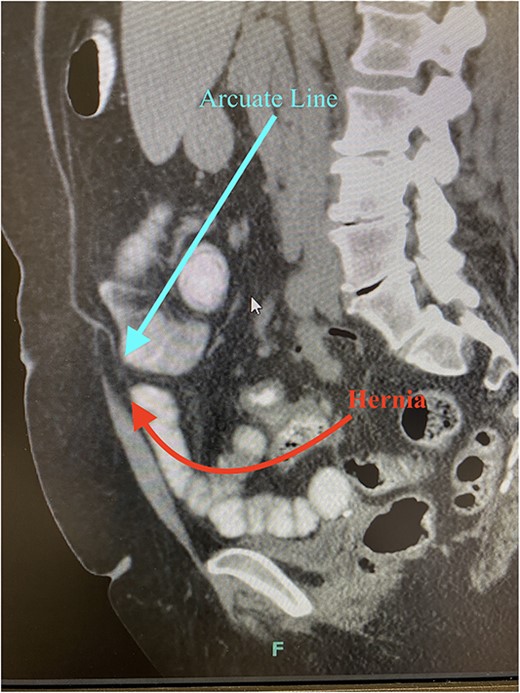 CT imaging demonstrates separation of the posterior sheath from the rectus abdominis at the arcuate line with herniated fat or viscus (sagittal imaging).