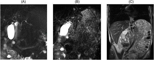 (A) MRCP 2017 displaying side branch IPMN with dilatation of the side branch, (B) MRCP 2021 displaying main duct involvement of the pancreas, (C) coronary MRT T2 scan with progressive side branch IPMN measuring 14 mm with possible focal discrete involvement of the main duct and partly irregular cystic changes.