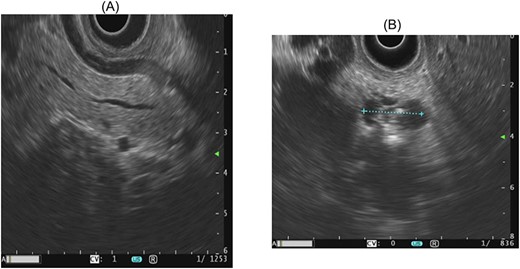 Endosonographic image morphology of a main duct IPMN, as well as progressive side branches with worrisome features, including dilatation of the main pancreatic duct and abrupt changes in the diameter.
