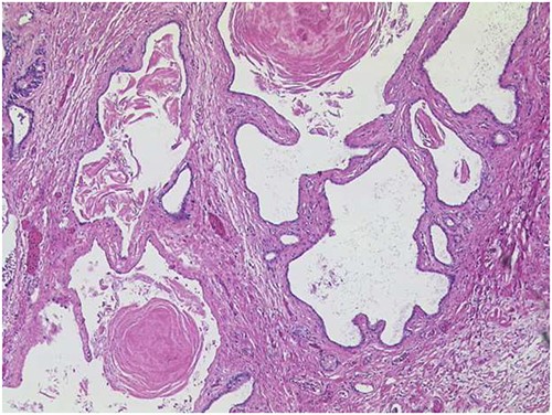 ACT of the pancreas with cysts of varying sizes, surrounded by fibrotic pancreatic parenchyma (HE ×50). On cross-section, the lesion is composed of multilocular cysts in the entire pancreas, measuring up to 1.1 cm.