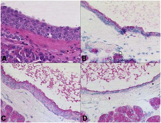 Cysts aligned by epithelium with acinar differentiation. The cyst lumina contain enzymatic secretions. Immunohistochemical stains confirm the acinar differentiation (A: HE, B: trypsin, C: chymotrypsin, D: BCL10 x200).