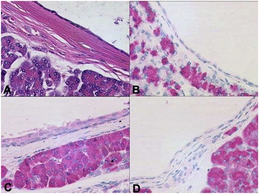 Distinct regions of ductal differentiation lack the immunohistochemical evidence of acinar cell markers (A: HE, B: trypsin, C: chymotrypsin, D: BCL10 x20).