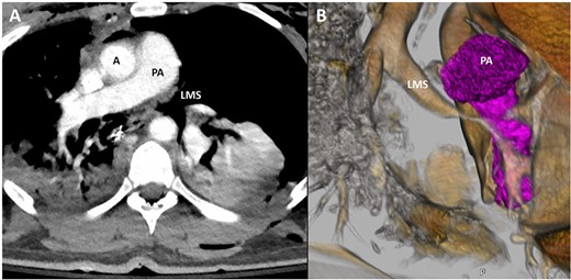 Representative image of axial slice of CT scan (A) and coronal 3D reconstruction (B) demonstrating narrowing of LMS secondary to bronchial injury; A, aorta; PA, pulmonary artery; LMS, left main stem.
