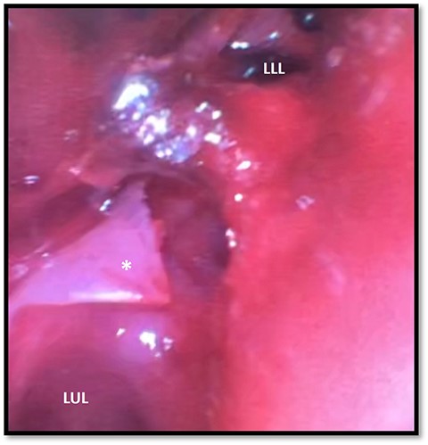 Bronchoscopy demonstrating left main stem bronchial tear (*) just proximal to the take between the LUL and LLL bronchi division; a hematoma can be seen obstructing the full view of the LLL; LUL, left upper lobe; LLL, left lower lobe.