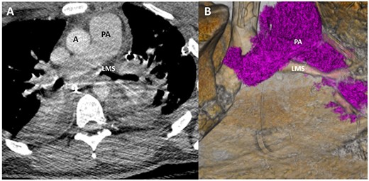 Representative image of axial slice of CT scan (A) and coronal 3D reconstruction (B) on HD 4 showed marked improvement in LMS patency.