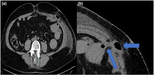 (a, b) Computed tomography imaging with TSH and intestinal involvement (blue arrows).