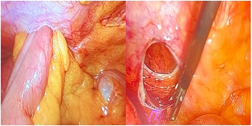 Intraoperative findings before and after hernia repair.