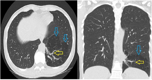 The CT scan shows a hypodense part in the left lower lobe (blue arrows) with an aberrant artery (yellow arrows) arising from the thoracic aorta.