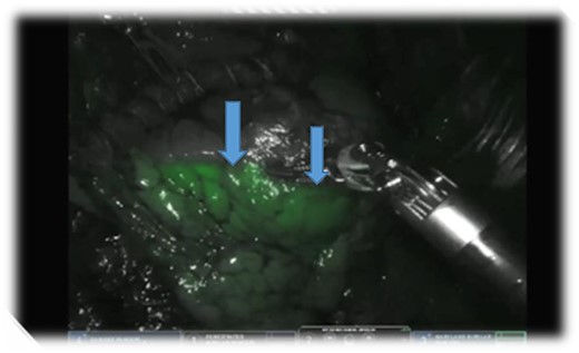 ICG showing the delineation of PS.