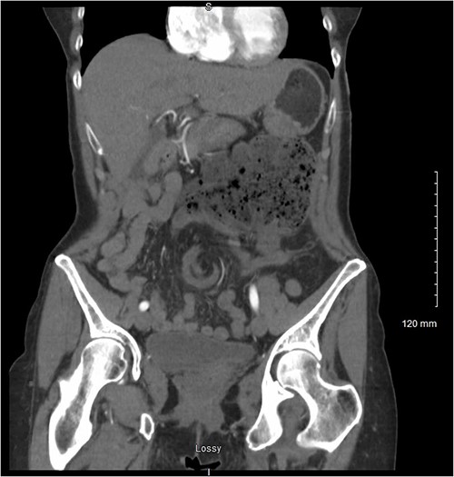 Coronal view of the patient’s CT abdomen and pelvis showing a central mesenteric swirl and adjacent fecalised bowel concerning for volvulus.
