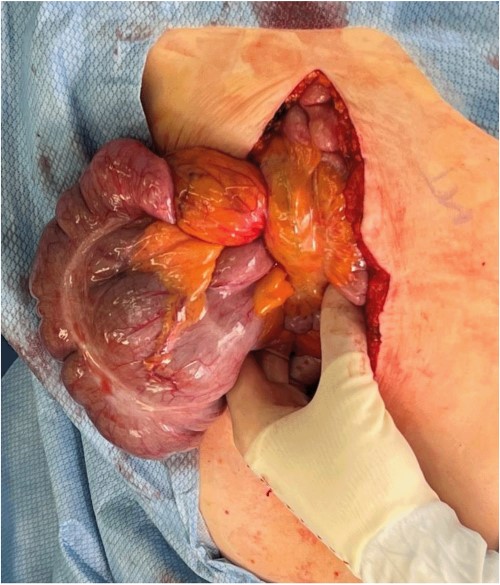 Evisceration of the midgut volvulus upon entry into the abdomen.