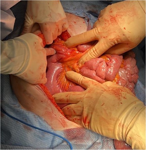 Identification of Ladd’s bands and lack of retroperitoneal course of the duodenum after detorsion of the midgut volvulus.