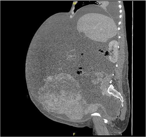 Abdominal CT scan shows huge ascites.
